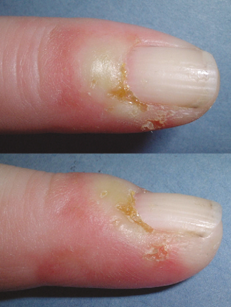 Yellow spots on nails can signal towards these 10 health issues | Times of  India
